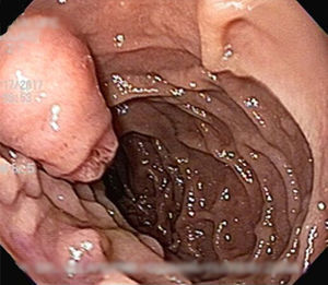 Ampulla with posterior “pregnant” aspect.