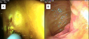 A) Tiny angiodysplasias in the duodenal mucosa, with argon plasma application. B) Angiodysplasia in the jejunal mucosa.