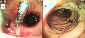 A) Diverticulum of the ileum with an adhered coagulate and visible vessel with 2 hemoclips. B) Benign ulcer in the ileum.