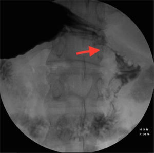 Esophagogastroduodenoscopy image showing the ulcerated lesion in the first part of the duodenum.
