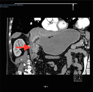 Contrast-enhanced abdominal CAT scan showing the thickening of the gastric antrum and the duodenal bulb walls.