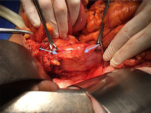 Annular pancreas, shown between the two arrows.