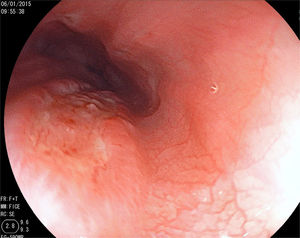 An ulcer measuring approximately 2cm, with raised edges covered with a scant quantity of fibrin, and another smaller mirror-image ulcer are shown.
