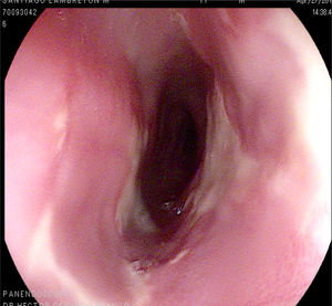 An ulcer measuring approximately 1.5cm covered in fibrin with irregular edges and another smaller mirror-image ulcer are shown, along with other proximal fibrin zones.