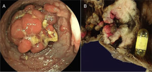 A) Colonoscopy showing the presence of a large polyp. B) Surgical specimen that shows the intestinal lumen with countless polyps and the video capsule obstructing the lumen at the stenosed zone in the ileum.