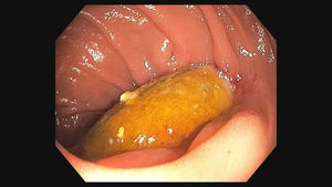 Esophagogastroduodenoscopy confirmed aortoenteric fistula.