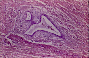 Medium magnification photomicrography (H&E) with endometrial glands between the muscle fibers of the appendiceal wall.