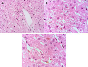 Hematoxylin & eosin stain at x100 shows normal architecture of the portal area a). Mild cholestasis hepatopathy due to the presence of intracytoplasmic cholestasis and Kupffer cells with phagocytosed biliary pigment can be observed in the hepatic lobule b), as well as intracanalicular cholestasis c).