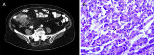 A) Abdominal CT scan showing irregular thickening of the cecum, with pericecal fat and terminal ileum infiltration, as well as multiple regional adenopathies. B) Histology study (H/E stain, x400): adenocarcinoma of the colon with signet ring cell pattern (arrow).