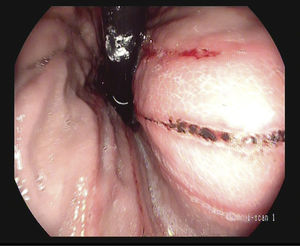 Retroflexed view of linear ulcers with hematin on their surface, Forrest IIc.