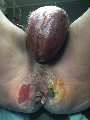 Preoperative image. Cellulitis and necrotic plaques at the level of the two ischioanal fossae, extending to the perineum and testes.