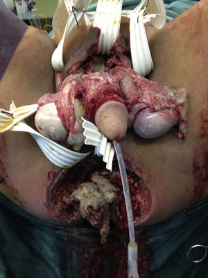 Postoperative image after ample debridement and placement of a silastic drain.