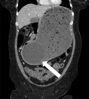 Oblique coronal CT image showing the same findings.