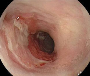 Endoscopic control after ESD (30 days). Patient received prophylactic oral corticoid therapy for stricture for 4 weeks.