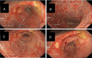 A-D) Oral panendoscopy images showing pale and nodular mucosa of the gastric corpus and antrum with unaffected areas and numerous, extensive, fibrin-covered ulcers of varying sizes (10-25mm).