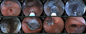 Steps of the G-POEM procedure. A) Initial viewing of the pylorus prior to the procedure. B) Injection. C) Longitudinal incision. D) Creation of the submucosal tunnel. E) Myotomy of the pyloric muscle. F) Incision at the end of the procedure. G) incision closure with hemoclips. H) The pylorus is clearly observed to be more open after the procedure.