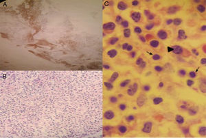 Bone marrow biopsy. A) Positive staining for CD20. B) Diffuse infiltration of small lymphoid cells and mature plasmacytes, H&E staining, x40. C) Arrows: lymphocytes, Arrowhead: plasmacyte, H&E staining, x100.