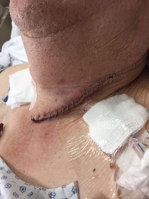 Clinical anastomotic leak, with the presence of surgical wound erythema and the drainage of saliva through a Jackson-Pratt drain, confirmed through amylase testing.