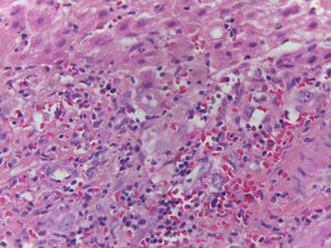 Liver biopsy with hematoxylin-eosin stain showing lymphocyte proliferation in the portal triad, with damage to the ducts.