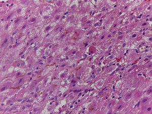 Liver biopsy with hematoxylin-eosin stain showing the liver lobule, apoptotic hepatocytes and regenerative changes.