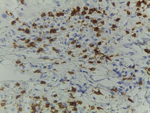 Liver biopsy with immunohistochemistry against CD8+, positive for cytotoxic T lymphocytes, consistent with GVHD.