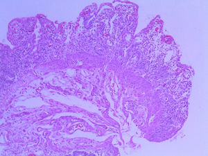 Intestinal biopsy with hematoxylin-eosin staining showing ulceration of the intestinal mucosa with an increase in the surface area of the intestinal crypts.