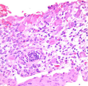 Intestinal biopsy with hematoxylin-eosin staining showing mega-nucleated cells and intraepithelial inflammatory infiltrate.