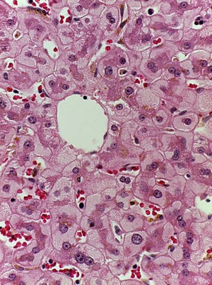 Liver biopsy with hematoxylin-eosin staining showing perivenular hepatocytes with clear, granular cytoplasm and iron deposits.