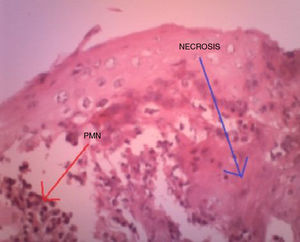 Permeation of polymorphonuclear neutrophils and areas of necrotized epithelium.