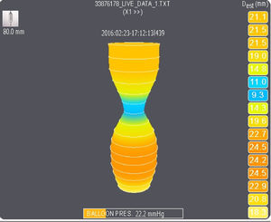 EndoFLIP® image of the pylorus at 40 cc balloon volume distension.