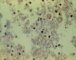 Entamoeba histolytica trophozoites in the wall of the colon, identified in the histopathology study of the patient.