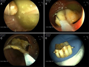 A) Dental prosthesis impacted in the diverticulum. B) Loop extraction of the prosthesis. C) Passage of the prosthesis through the anastomosis. D) Extracted dental prosthesis.