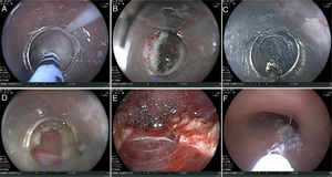 Procedural technique: A) Injection. B) Incision. C) Submucosal tunnel. D and E) Complete myotomy. F) Incision closure with cyanoacrylate.