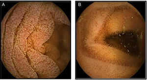 Capsule endoscopy. 2A. Mucosa with edema and erythema, that produces thickening of the villi. 2B. Control showing the disappearance of the edema and erythema, with normalization of the thickness of the villi.