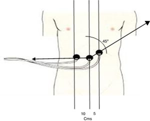 Placement of the 3 cutaneous electrodes to register gastric electrical activity. The first electrode is placed at the midpoint between the xiphoid process and the umbilicus. The second electrode is placed 5cm to the left of the first, at a 45° angle. The ground electrode is located 10cm to the right of the first electrode.