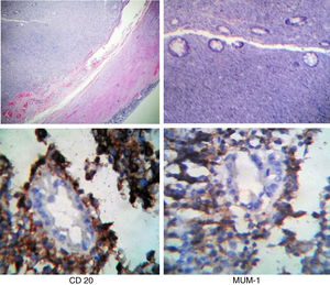 Histologic sections of the appendiceal neoplastic lesion formed by neoplastic lymphocytes (H&E and immunohistochemistry).