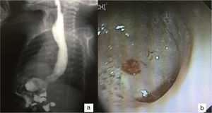 a) EGD study showing the dilation of the body of the esophagus and a tubular gastric remnant; b) endoscopic image of the apparent gastric remnant.