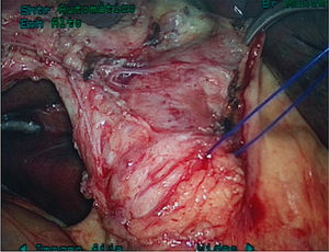 Laparoscopic dissection of the common bile duct landmarked with sutures (Prolene® 3-0).