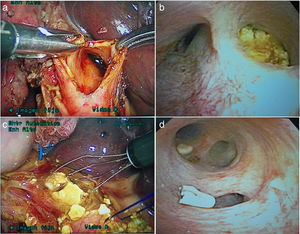 Series showing the steps during the laparoscopic examination of the biliary tract: a) choledocotomy; b) laparoscopic cholangioscopy (impacted intrahepatic duct stone); c) extraction of multiple stones with the Dormia basket; d) cholangioscopy after extraction of the stones.