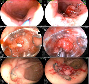 A) A guidewire is passed through a small tracheoesophageal fistula for its adequate identification. B) Ovesco clip released at the fistula site, with complete closure. C) Hiatal hernia perforation during the passage of the nasogastric tube. D) Use of the Twin Grasper®: moment of grasping the tissue to then release the clip. E) Suture dehiscence of the Graham patch in the stomach (anterior wall of the proximal antrum). F) Closure of the fistulous orifice with the Ovesco clip.