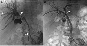 A) Cholangiography for percutaneous internal-external biliary drainage (arrows) confirming a hilar stricture (arrowhead). B) Cholangiography at 10 days shows a normalized situation, with no more hilar stricture (arrowhead).