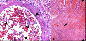 A) Histopathologic study of the intestinal mucosa showing ulceration and bleeding and thick hyphae with focal bulbous dilation and branching at right angles. B) Vascular invasion with bleeding, thrombosis, ischemic necrosis, and acute inflammatory infiltrate is also shown.