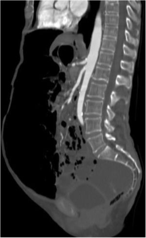 Abdominal tomography scan with sagittal reconstruction showing abundant pneumoperitoneum, pneumatosis intestinalis, and free fluid in the pelvic cavity.