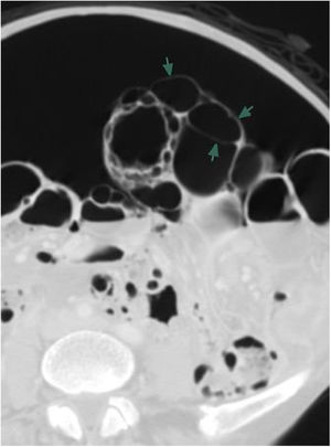 Axial view of the abdominal tomography scan showing abundant pneumoperitoneum and pneumatosis intestinalis with a cystic pattern (arrows).