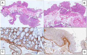 Anatomopathologic analysis of the specimen. A) Panoramic view of the specimen. B) Chronic inflammatory infiltrate and mucosal thickening. C) Glandular abnormalities. D) Thickening of the muscularis mucosae.