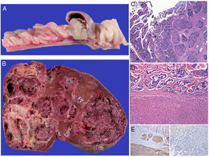 Macroscopic aspect of the neuroendocrine carcinoma of the jejunum (A) and the almost total substitution of the hepatic parenchyma by metastases (B). In both organs the lesion is well-differentiated, with classic carcinoid patterns (C) and sclerosis of the neighboring stroma (C and D). Reactivity for the endocrine differentiation markers was diffuse and intense (chromogranin A in image E), with focal nuclear expression for the MIB-1 cellular proliferation antibody (Ki-67 < 2%).