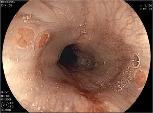 Endoscopic image of IP with FICE.