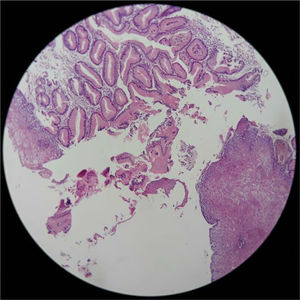 Histologic image of the heterotopic gastric epithelium.