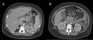 A and B The image shows the edematous pancreas with no necrosis, surrounded by a non-encapsulated fluid collection. The size and morphology of the liver, spleen, and both kidneys are normal. The size of the gallbladder is normal, with no cholecystitis or signs of stones.