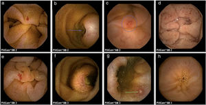 Images obtained through capsule endoscopy: SB2: a) angiodysplasia, b) ulcerated submucosal tumor, c) ulcer, d) red spots. SB3: e) angiodysplasia, f) ulcerated submucosal tumor, g) ulcer, h) red spots.